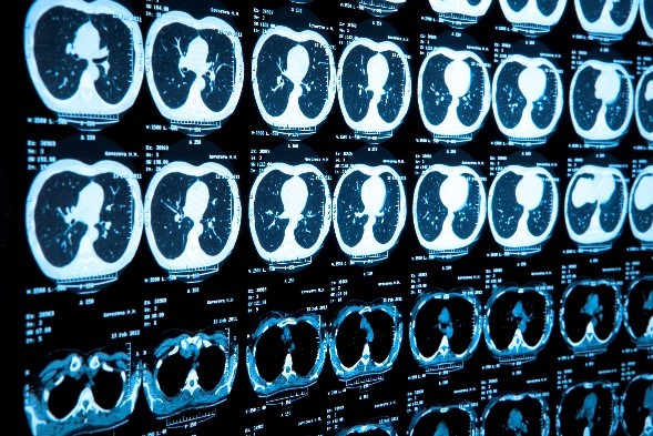 Picture of lung cancer screenings