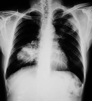 Picture of a Lung Cancer Screening