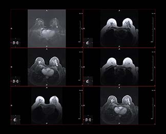 Picture of an Abbreviated Breast MRI procedure