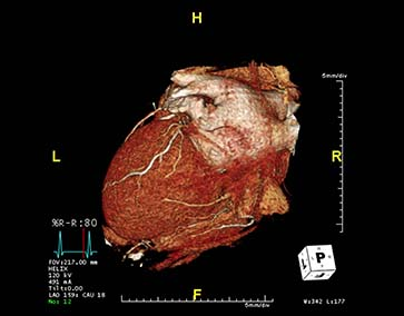 Picture of an HeartFlow procedure